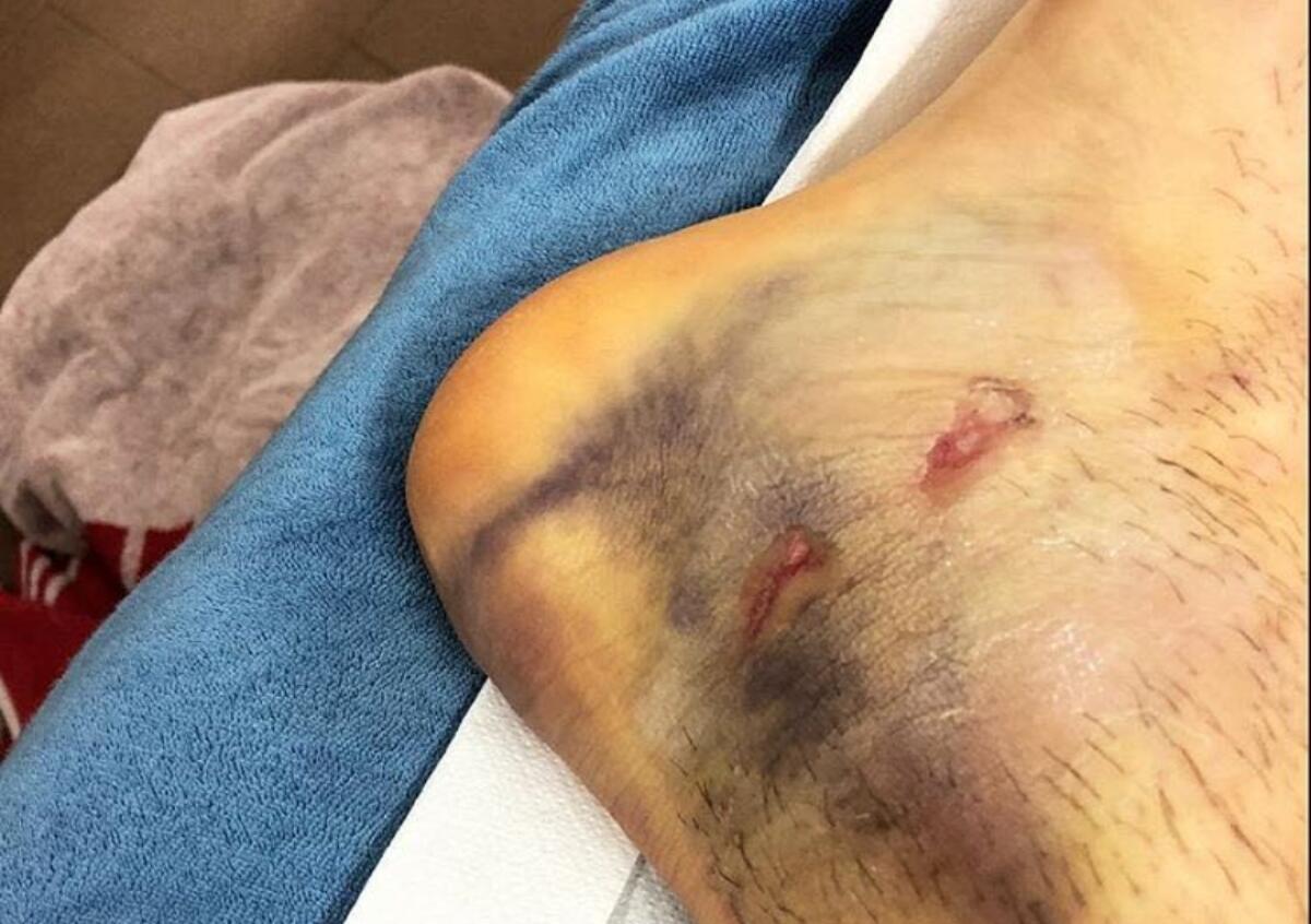 Kalinic e la sua assenza a Firenze contro la Fiorentina. Il croato mostra il motivo su Instagram - 