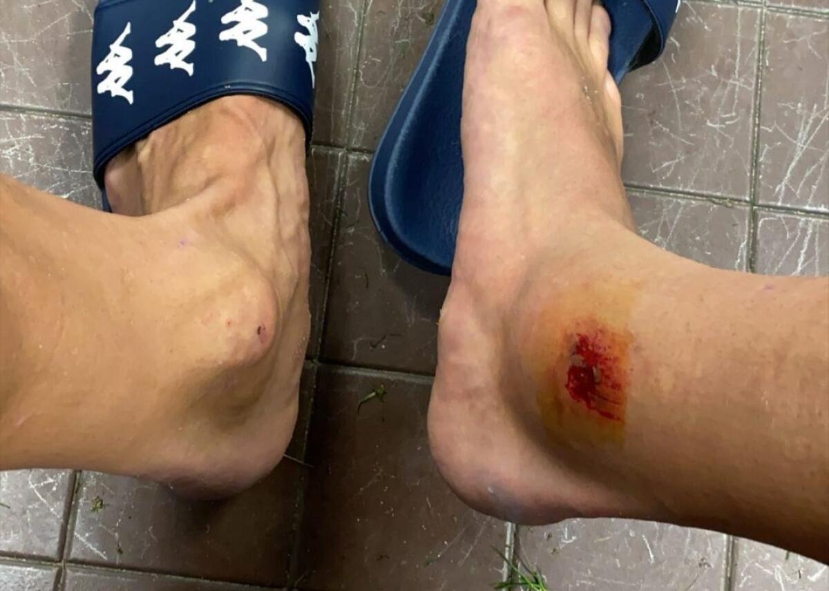 Lirola mostra come è ridotta la sua caviglia dopo la partita vinta contro l'Udinese - 