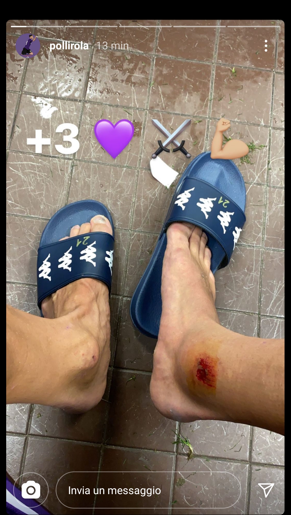 Lirola mostra come è ridotta la sua caviglia dopo la partita vinta contro l'Udinese