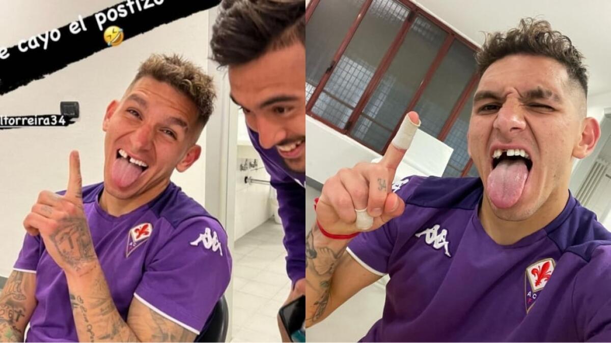 Torreira guerriero viola, perde il dente durante la partita contro l'Inter e nello spogliatoio se la ride - 
