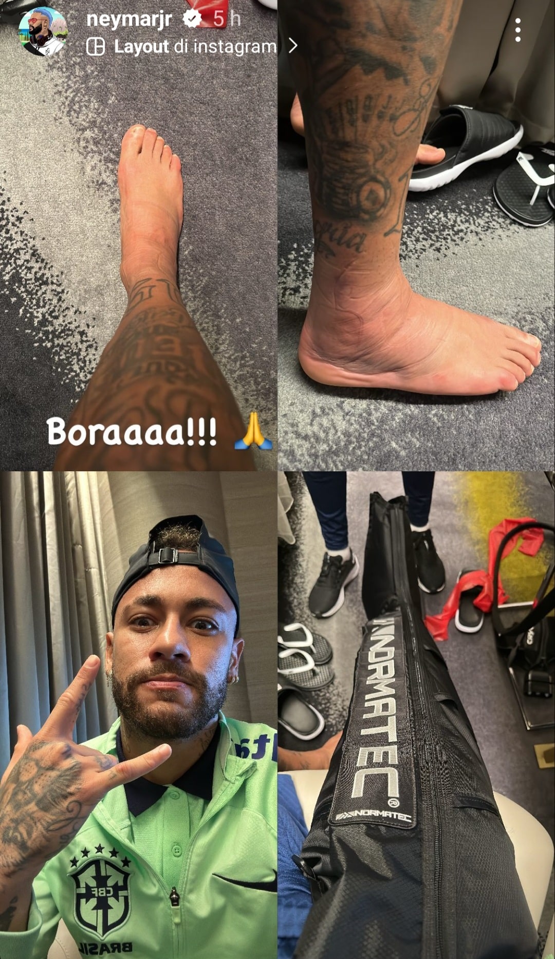 Neymar non ha ancora superato lo scontro con Milenkovic, mostra su Instagram la caviglia gonfia