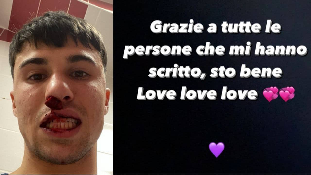 Bianco ha le ossa del naso fratturate. Verrà operato solo alla fine di questa stagione