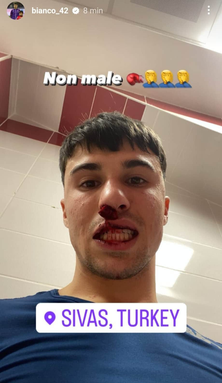 Italiano infuriato: "Bianco ha il naso rotto, è vergognoso. Colpito mentre non se lo aspettava"