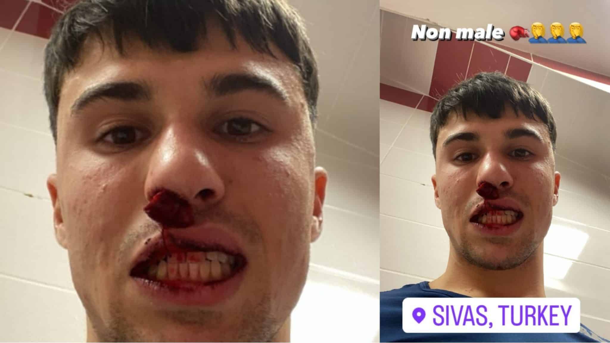 Il video dell'aggressione subita da Bianco. Pugno in pieno volto dal tifoso e naso rotto in campo