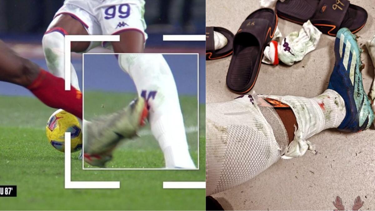 Kouamè mostra le condizioni della sua gambe dopo il fallo killer di Lukaku che gli poteva costare caro - 