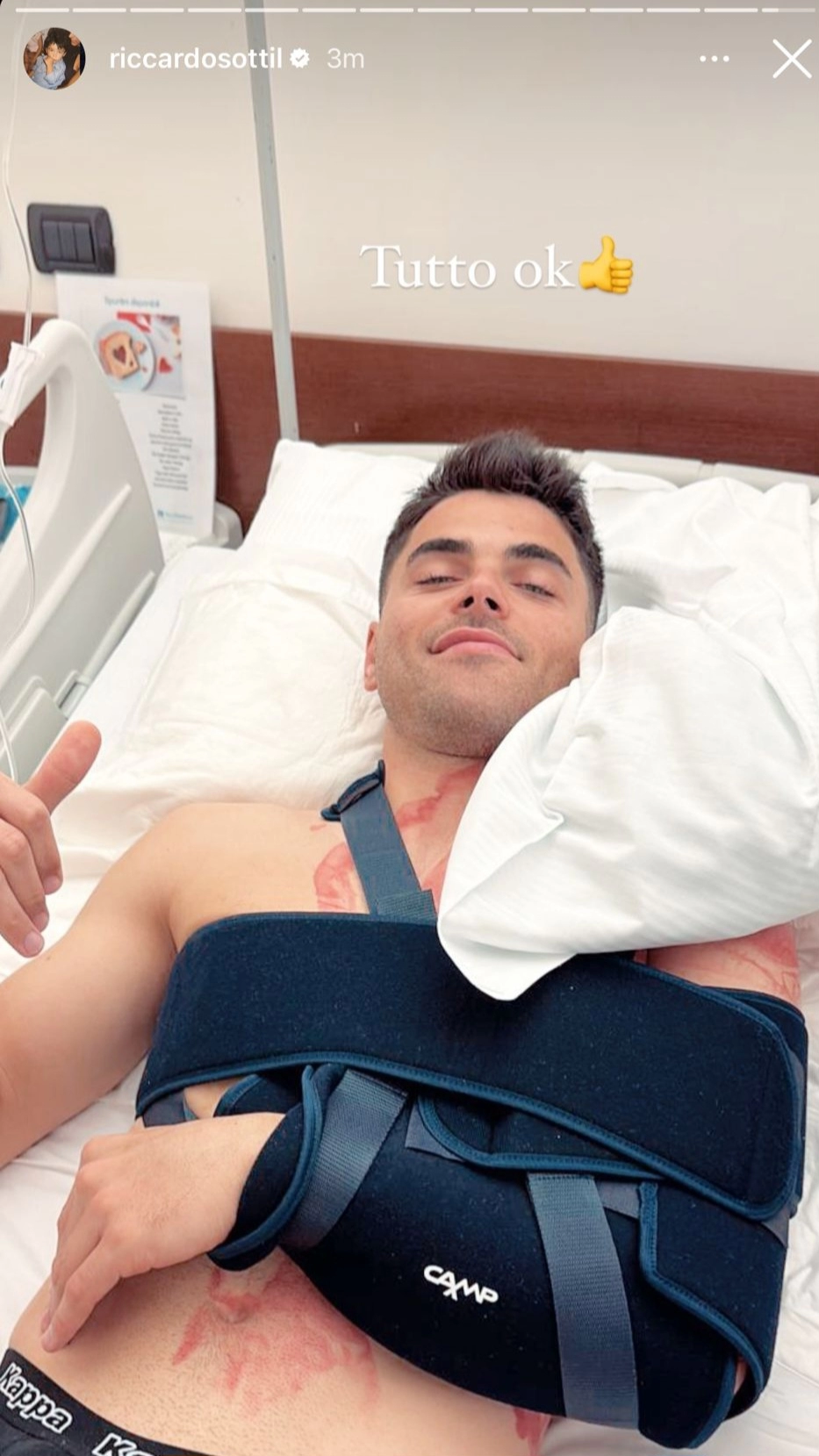FOTO, Sottil si è operato alla spalla sinistra, sorridente dopo l'operazione in ospedale